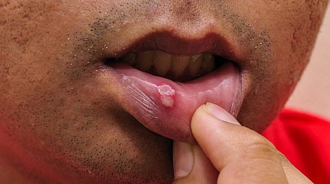 Discover Natural Relief for Mouth Pain with Nirgudi Leaves