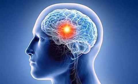 Understanding Stroke