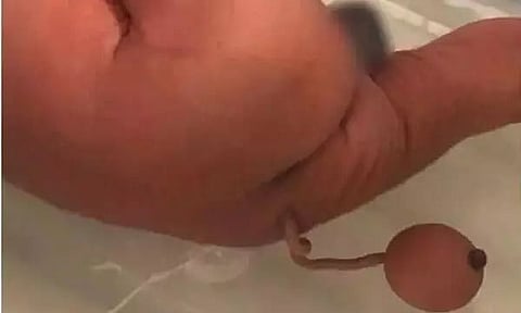 Baby Born With 'Tail' in Brazil: A 12-Cm-Long Limb With Ball-Shaped Mass at Tip