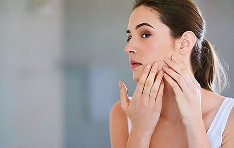 Winter acne breakouts