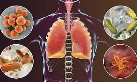 Everything About Pneumonia and Its Efficacious Treatment