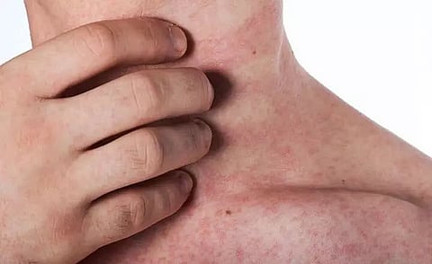 Anaphylaxis: Key feature of severe allergic reaction