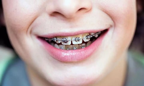 How to Fix Crooked Teeth: Teeth Alignment with Braces