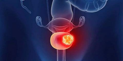 Why is bladder cancer more common among men?