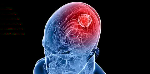 Lifestyle choices increase risk of developing brain tumours: Experts