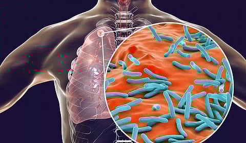 TB eradication challenges