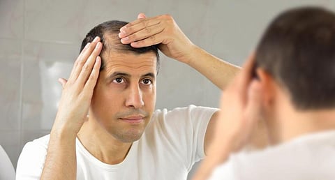Sandalwood for Baldness: Scientists Develop a Baldness Reversal Therapy