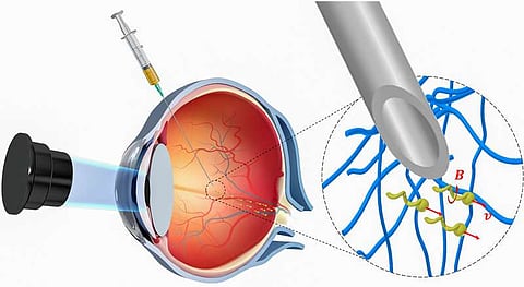 Novel Nanorobots to Propel Through Eyeballs