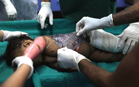 Fish Skin Cheaper, Less Painful in Treating Burns Than Bandages