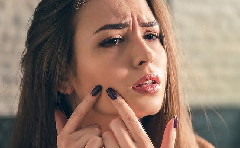 Expert Tips: How To Get Rid Of Heat Pimples Naturally