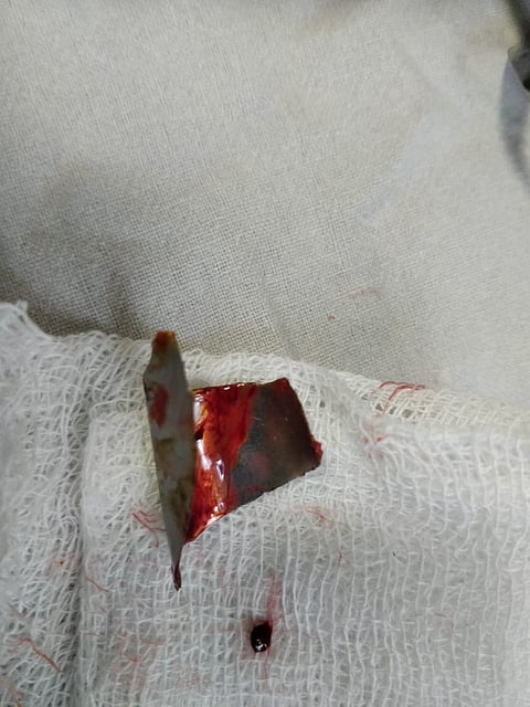 Fire cracker in human body