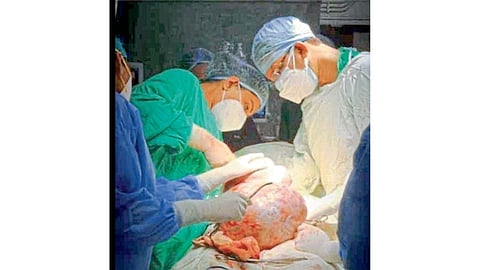 8 kg lump removed from woman stomach 