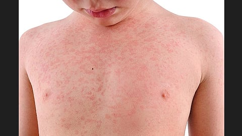 Measles Vaccine collapse vaccination schedule child health news pune corona 
