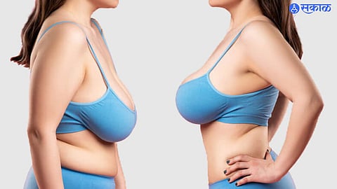 Breast Reduction Operation
