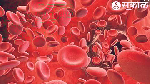 Hemophilia disease  ( clip art )