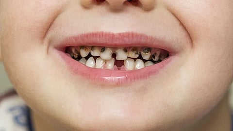 Tooth Decay Treatment 