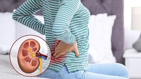 Kidney Stone Symptoms