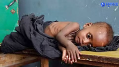 Pediatric experts focus on 48 severely malnourished children after a health screening of 53,266 children in the district.