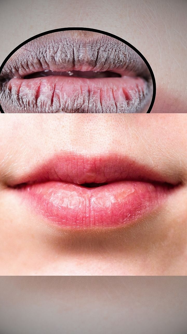 Effective Ways to Prevent Dark Lips and Keep Them Soft and Pink ...