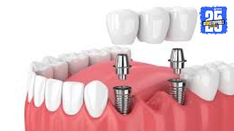 Nagpur News: दातांवरचे महागडे उपचार आता कमी खर्चात! नागपूरच्या तरुणाने बनविले स्वदेशी ‘डेंटल इम्प्लॉन्ट’ तंत्र