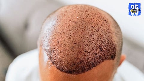 A young engineer lost his life during a hair transplant procedure due to alleged medical negligence at a private clinic.
