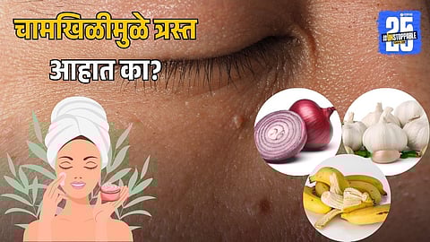 How To Treat Skin Tags At Home