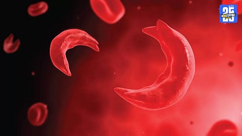 Sickle Cell