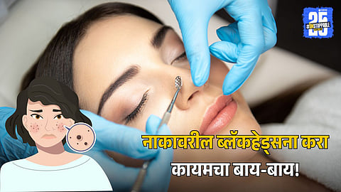 Nose Blackhead Remove: नाकावरील ब्लॅकहेड्स हटवायचेत? मग घरच्या घरी करून पाहा 'हे' 6 सोपे उपाय