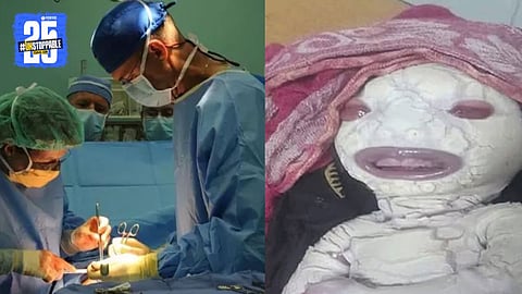 Alien-Like Baby Born in Rewa