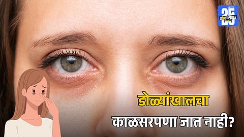 Dark Circles Under Eyes