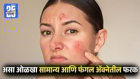 How to Identify Fungal Acne vs Regular Acne