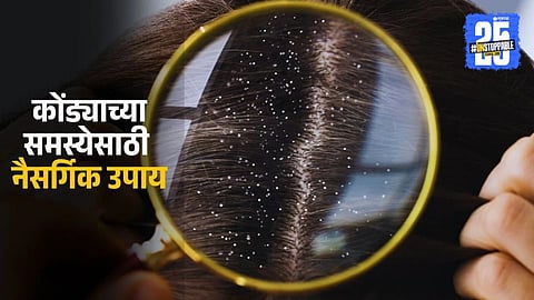 Best home remedies for dandruff and itchy scalp