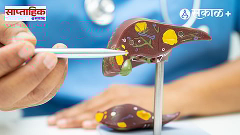 Gallstones