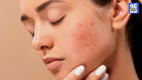 Heavy rains and unhygienic conditions in Solapur trigger rise in skin diseases like Tinea and Candida.