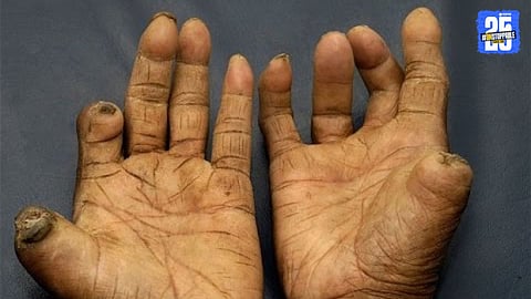 Leprosy Patient