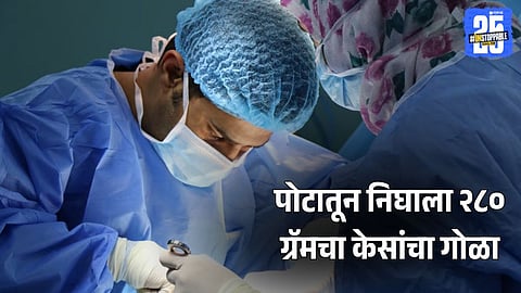 Pune Doctors Remove Rare Hairball from Girl's Stomach