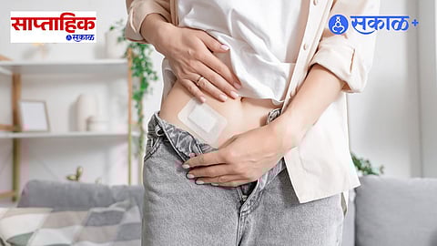 Frog Neobladder Technology Life After Bladder Surgery