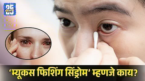 Mucus Fishing Syndrome