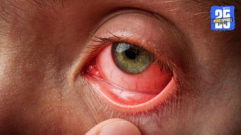 Person thoroughly washing hands with soap under running water to prevent the spread of conjunctivitis through hygiene