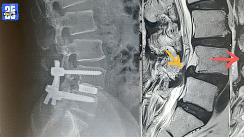 Understanding Spondylolisthesis: When Vertebrae Slip Out of Place