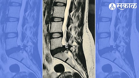 Stitchless Spine Surgery