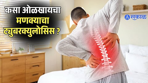 World Tuberculosis Day 2026