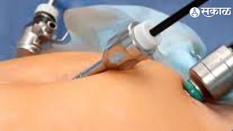 Professor’s Death Raises Questions on Cashless Surgery Practices in Solapur