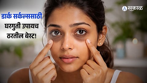 dark circles remedies