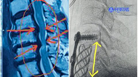 The Deceptive Nature of Nervous System: Disease in Neck, Symptoms in Fingers