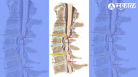 Spinal Cord Compression Symptoms
