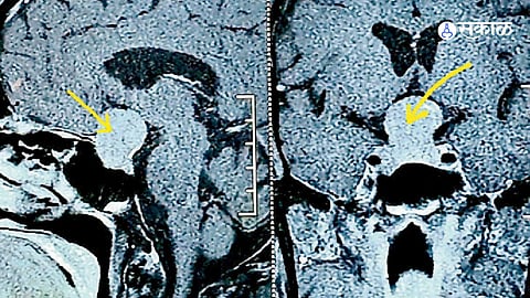 "तुमची अंगठी किंवा चपला बसत नाहीत?" शरीरातील हे बदल पिट्युटरी ग्रंथीच्या गाठीचे संकेत असू शकतात!