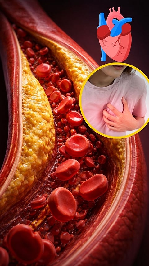 Causes of high cholesterol