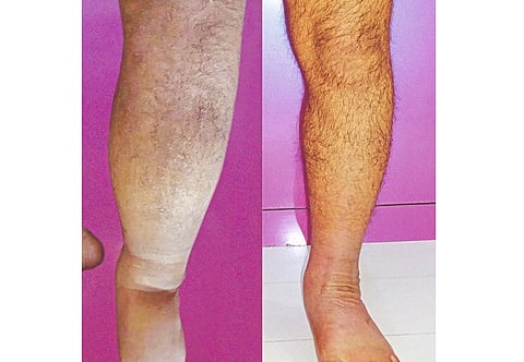 successful surgery on lymphedema patient in nagpur 