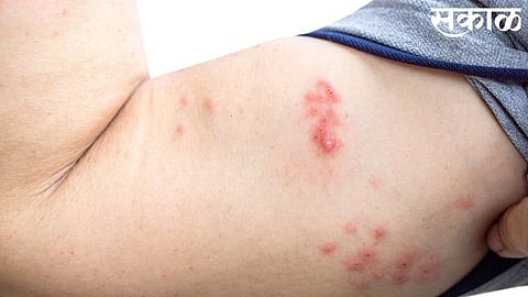 remove the infection of skin home made some tips available in kolhapur